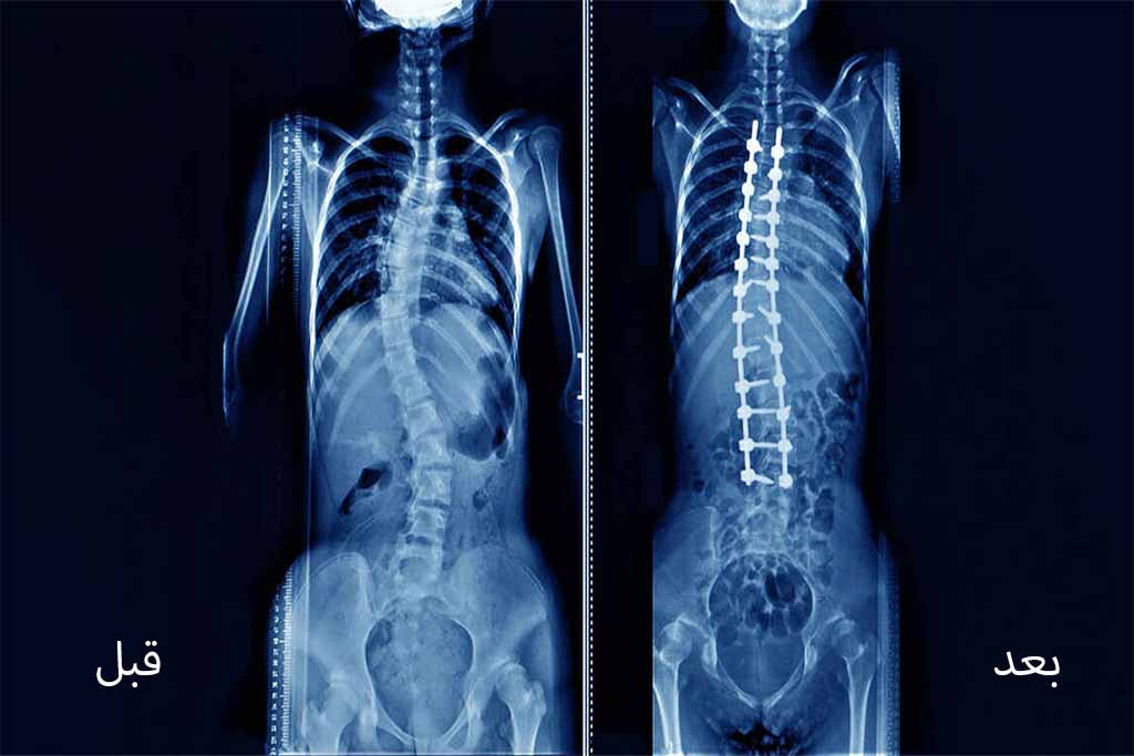 عکس رادیولوژی قبل و بعد از جراحی انحراف ستون فقرات 