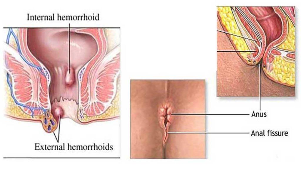 بیماری مقعد انواع بیماری های مقعدی کدامند