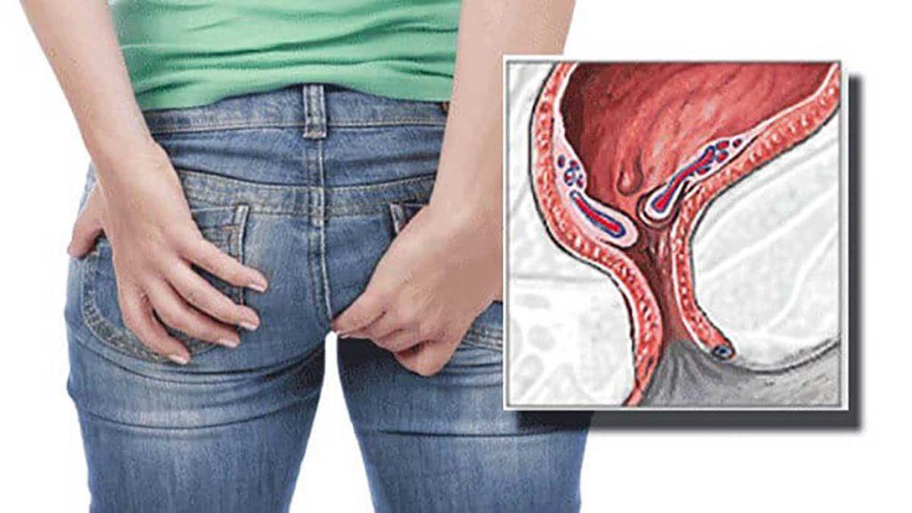 بی اختیاری مدفوع داشتن