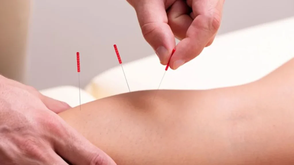 طب سوزنی طب سوزنی