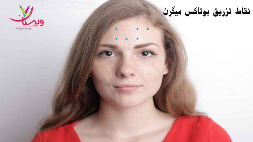 عوارض بوتاکس میگرن نقاط بوتاکس