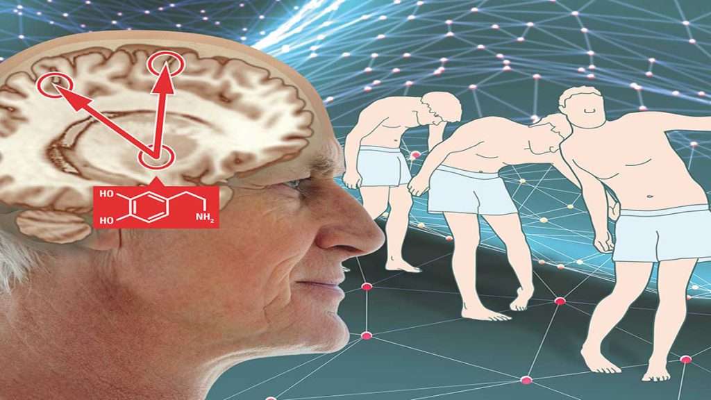 طول عمر بیماران پارکینسون