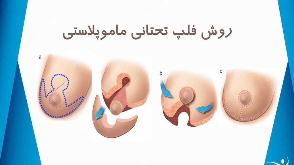 بهترین و متخصص ترین دکتر ماموپلاستی در تهران