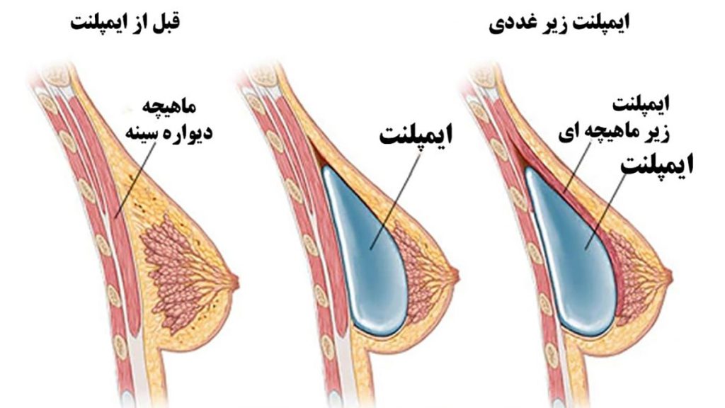 عمل ماموپلاستی چقدر طول میکشد+آیا بعدماموپلاستی می‌توان رابطه داشت+ماموپلاستی با بیمه تکمیلی انجام می‌شود+ماموپلاستی و شیردهی