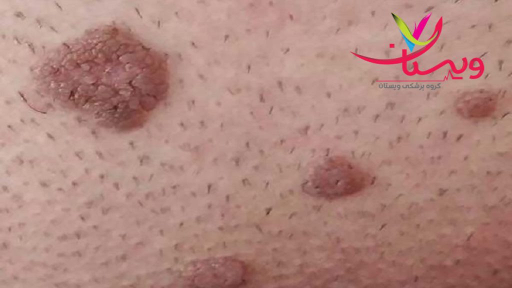 زگیل تناسلی مردان تصویر زگیل تناسلی مردان