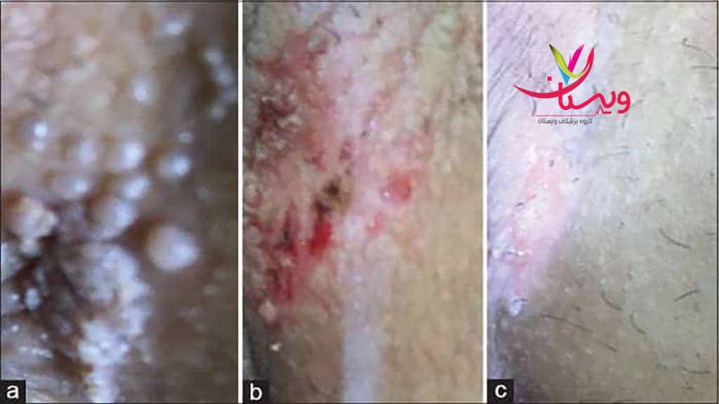 درمان زگیل تناسلی تصویری از 3 مدل زگیل تناسلی در دستگاه تناسلی مردان