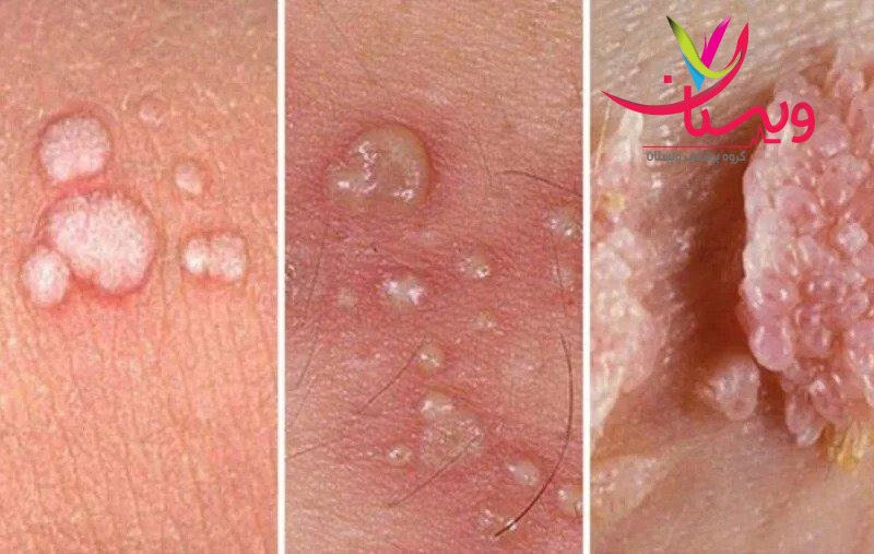 انواع زگیل تناسلی