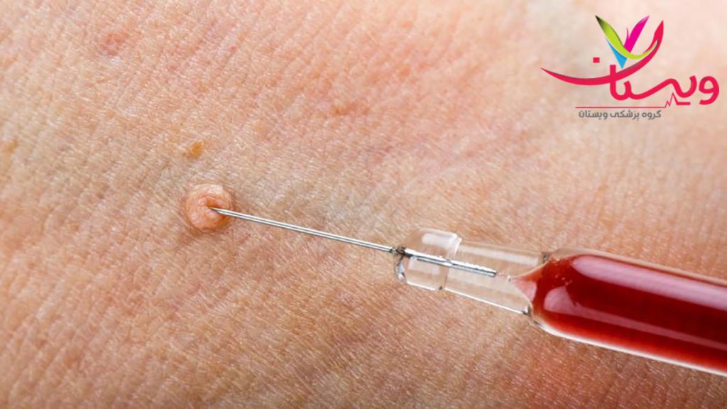 درمان تضمینی زگیل تناسلی تصویر تزریق دارو برای سوزاندن زگیل تناسلی