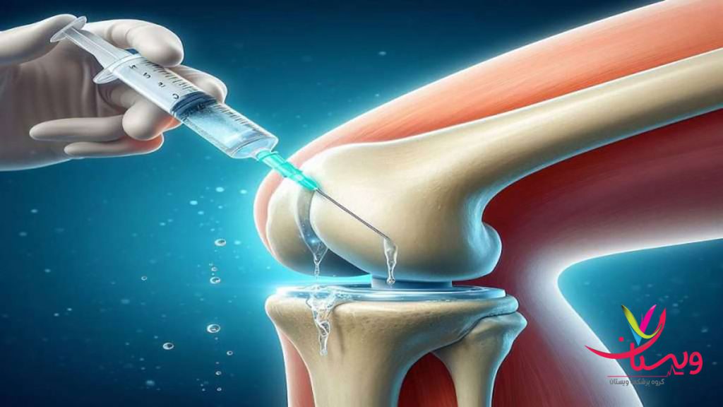درمان آرتروز زانو با تزریق آمپول ویسکور