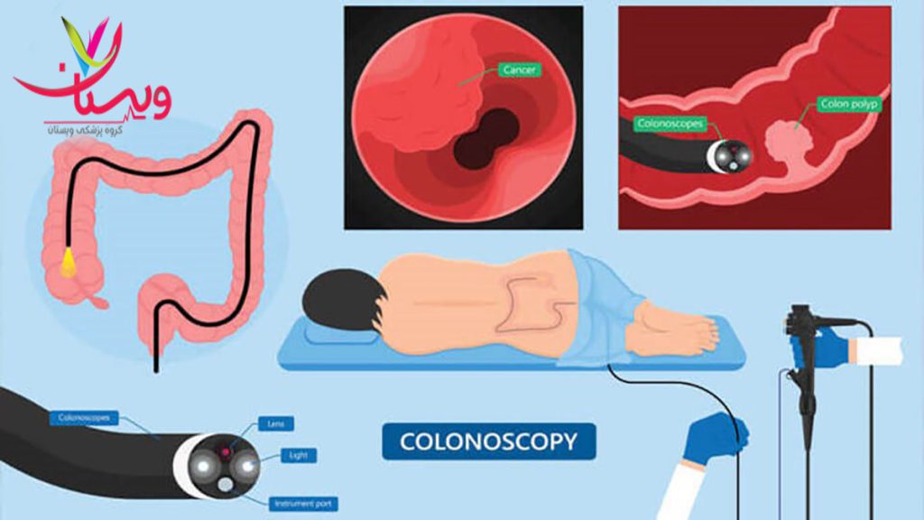 آشنایی با کلونوسکوپی تصویر اجزا و مراحل و نحوه انجام کلونوسکوپی