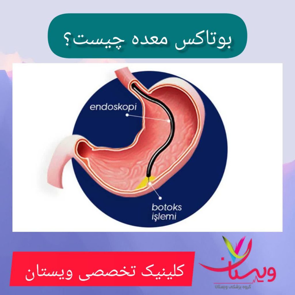 بوتاکس معده چیست؟ بوتاکس معده چیست؟ بهترین متخصص تزریق بوتاکس معده در تهران