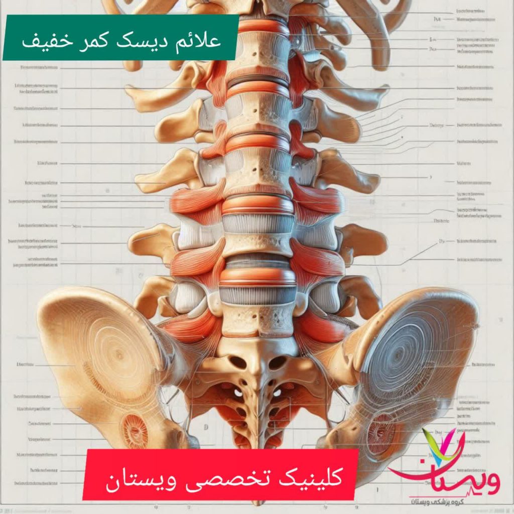 علائم دیسک کمر خفیف علائم دیسک کمر خفیف