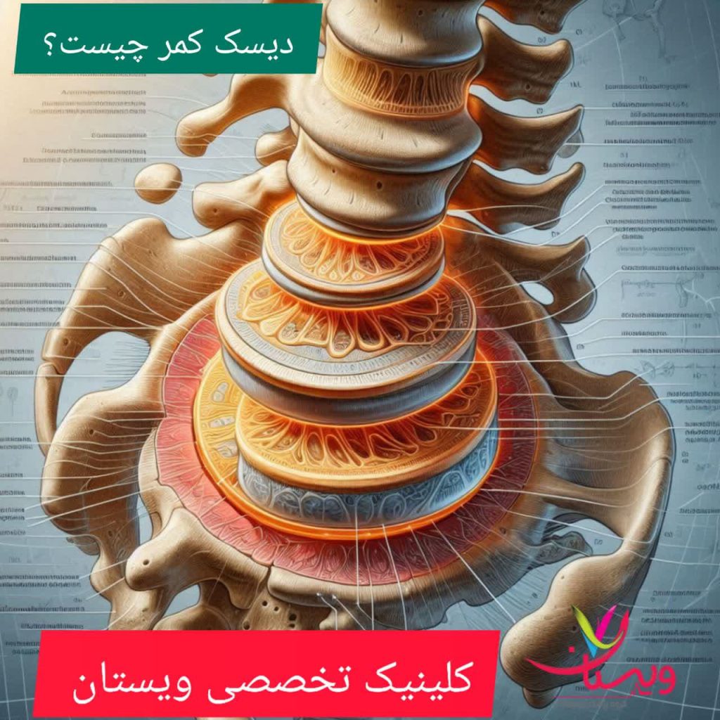 دیسک کمر چیست؟ دیسک کمر چیست؟