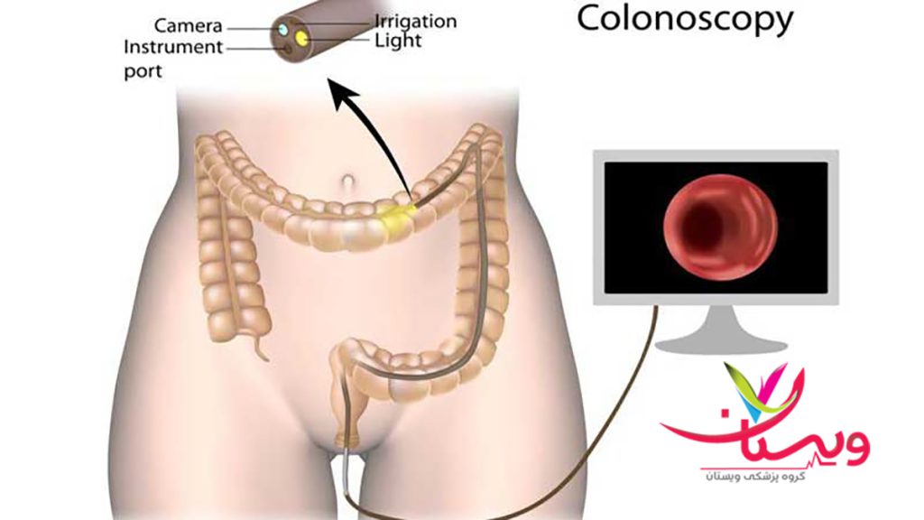 قیمت کلونوسکوپی با بیمه تکمیلی هزینه کولونوسکوپی با بیمه تکمیلی چقدر است؟