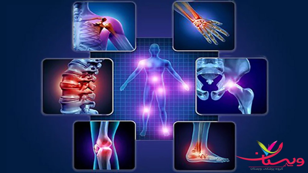 اندام های شایع مبتلا به آرتروز