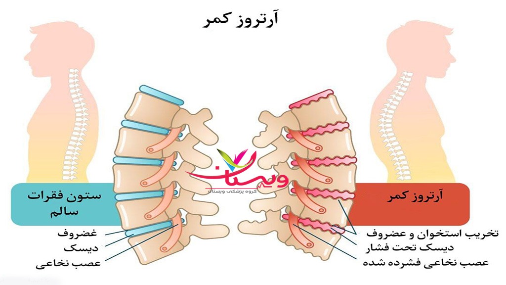 دیسک و آرتروز کمر مقایسه کمر سالم و کمر دارای آرتروز