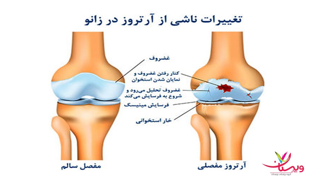 درباره آرتروز زانو مقایسه زانو سالم و زانوی آرتروز منتلا به آرتروز