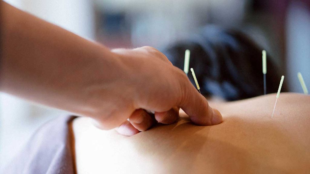 از بین بردن استرس با طب سوزنی