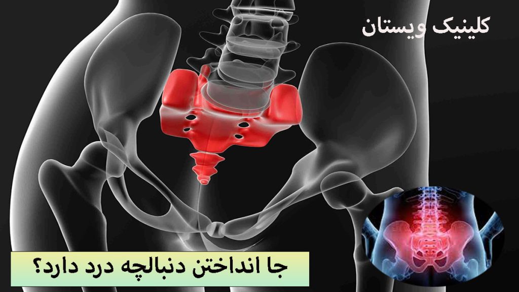 درد دنبالچه تصویری دیجیتالی از درد دنبالچه