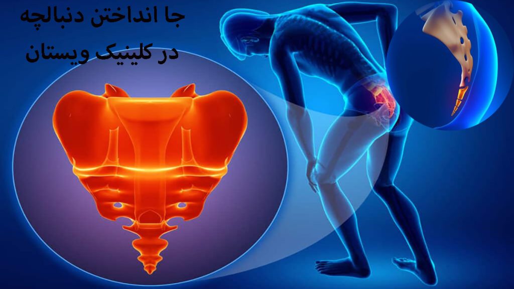 جا انداختن دنبالچه دو تصویر از درد دنبالچه