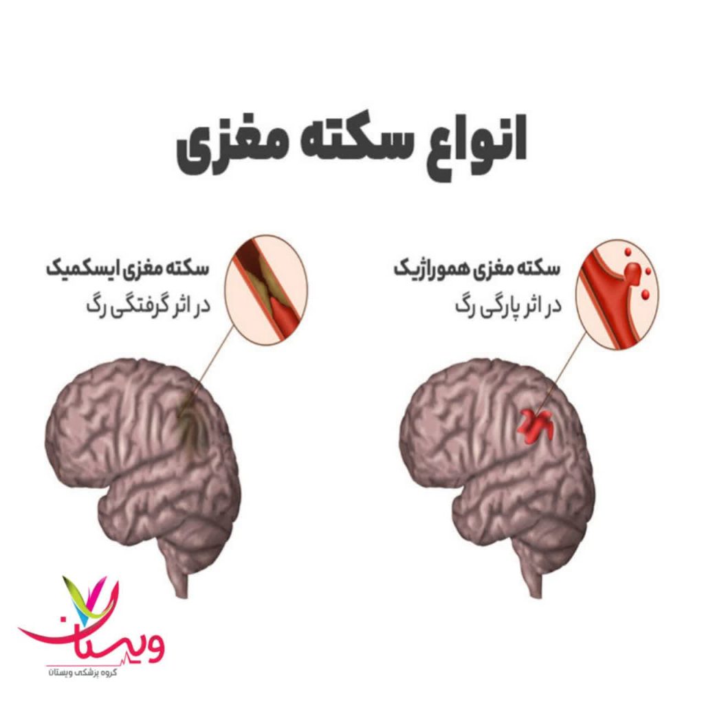 انواع سکته مغزی انواع سکته مغزی