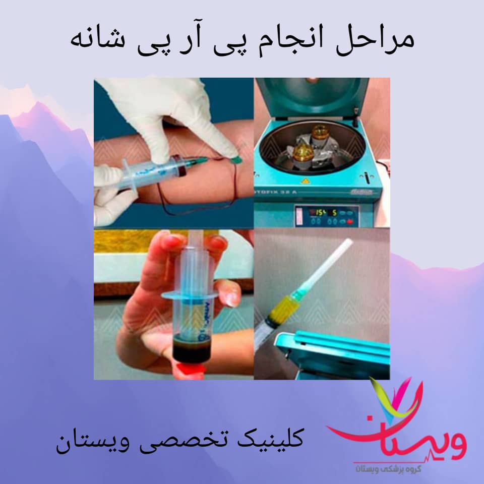 مراحل انجام پی آر پی شانه مراحل انجام پی آر پی شانه