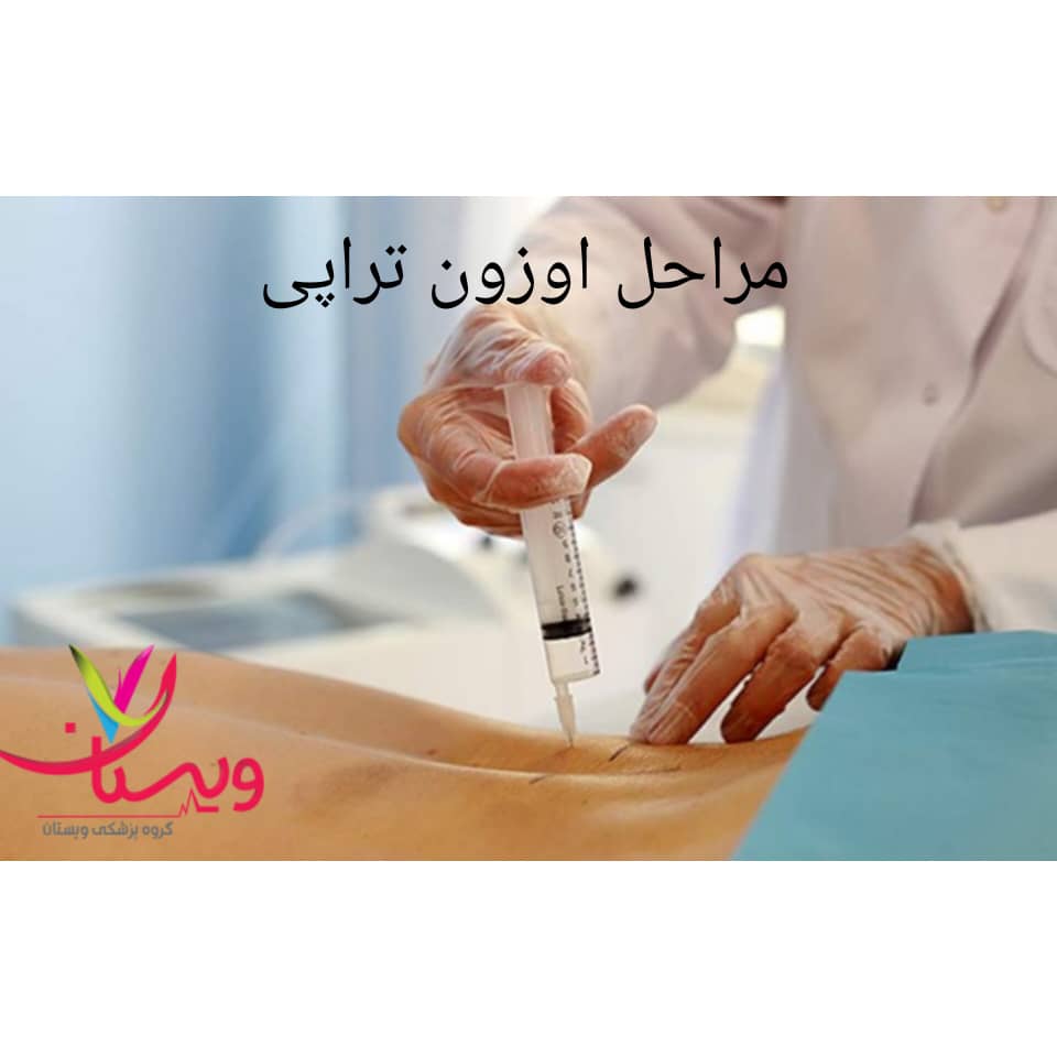 مراحل تزریق اوزون مراحل تزریق اوزون
