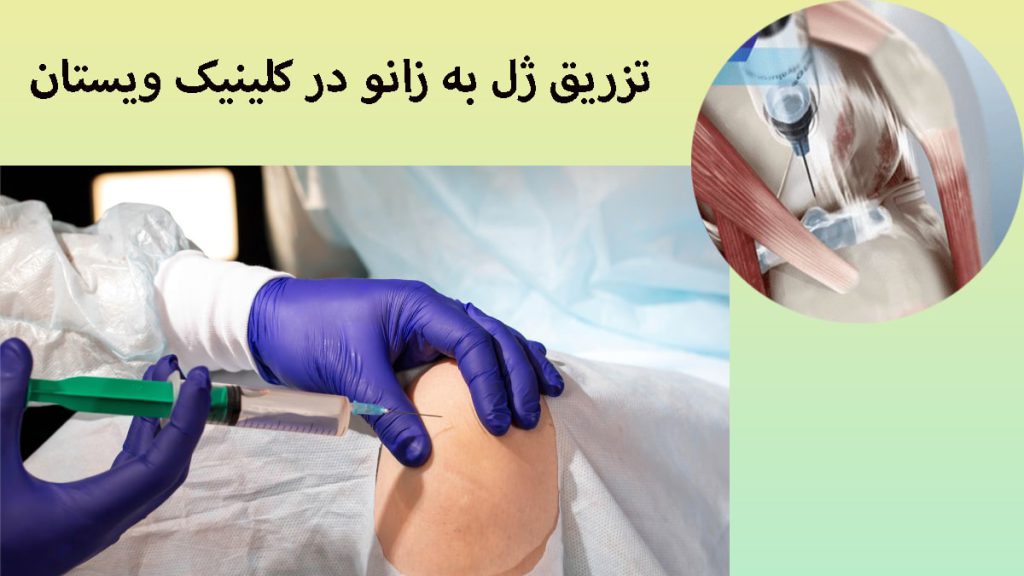 دو تصویر از تزریق ژل به زانو