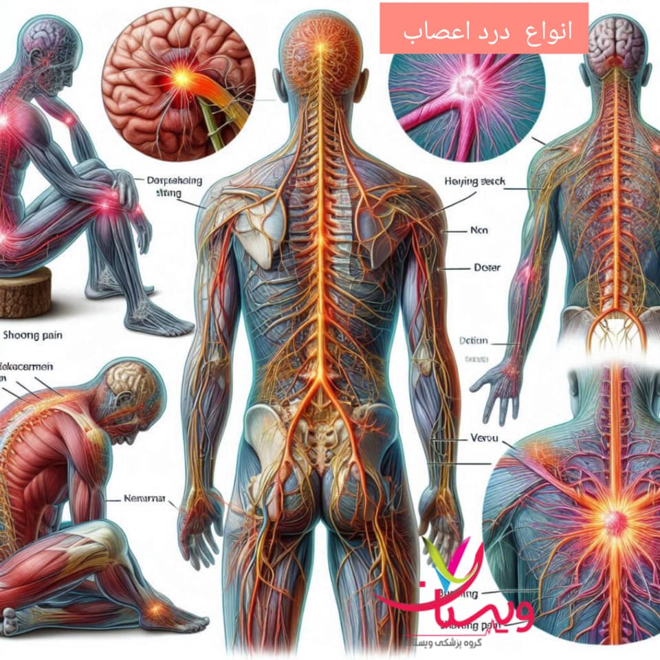 انواع درد اعصاب