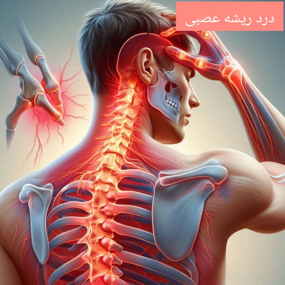 درد ریشه عصبی