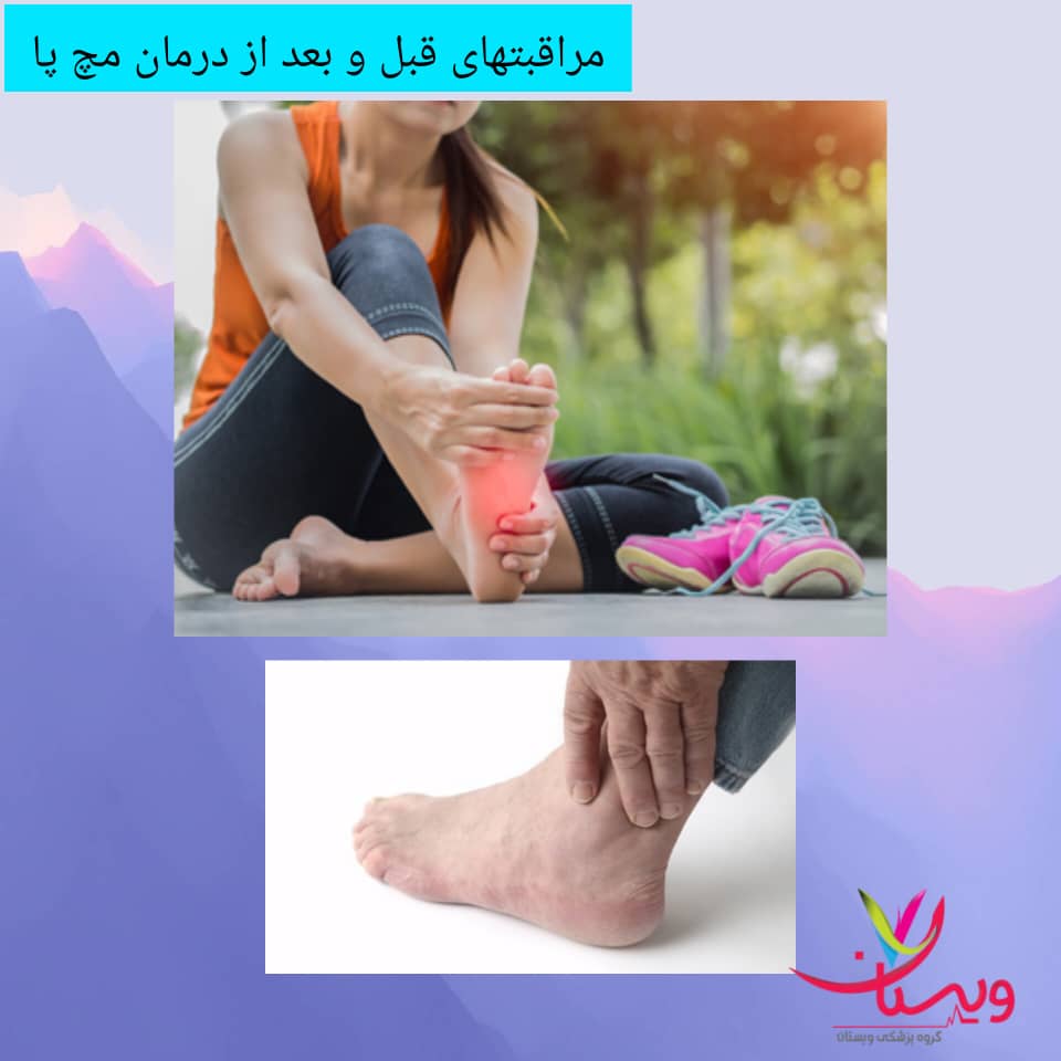 مراقبتهای قبل و بعد از درمان مچ پا مراقبتهای قبل و بعد از درمان مچ پا