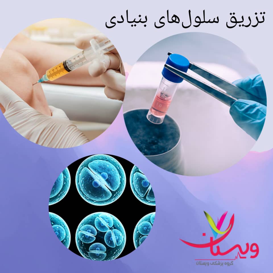 تزریق سلول‌های بنیادی