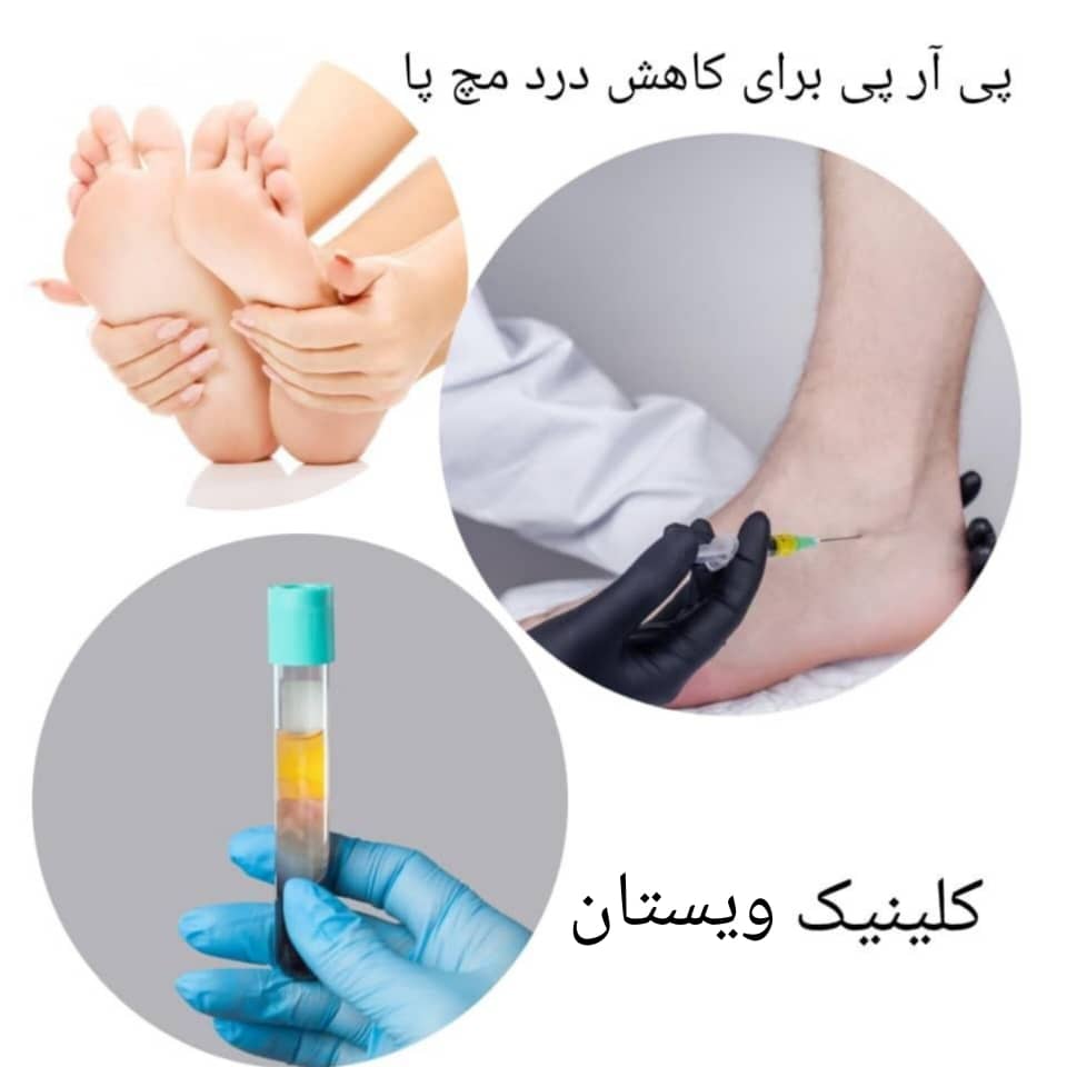 درمان پی آر پی برای کاهش درد مچ پا درمان پی آر پی برای کاهش درد مچ پا