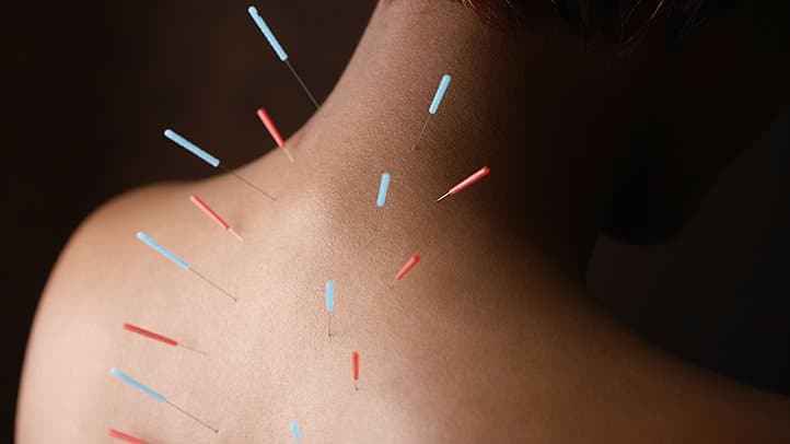 هزینه طب سوزنی برای افزایش قد هزینه طب سوزنی برای افزایش قد