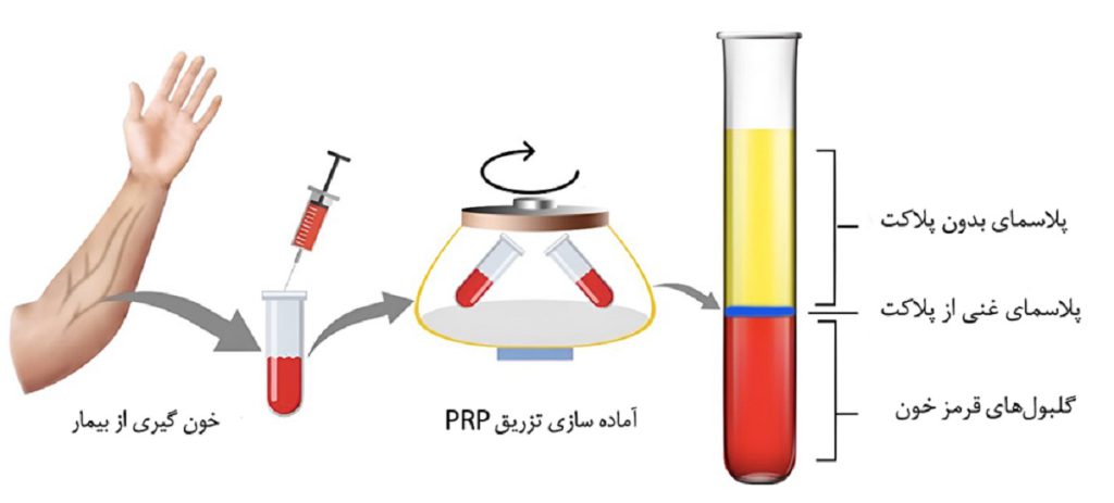 شرح فرآیند پی آرپی