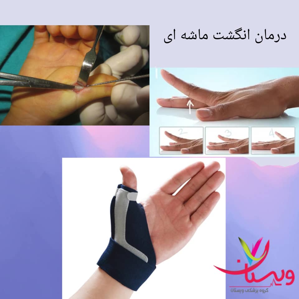 روش های درمان انگشت ماشهای روش های درمان انگشت ماشهای