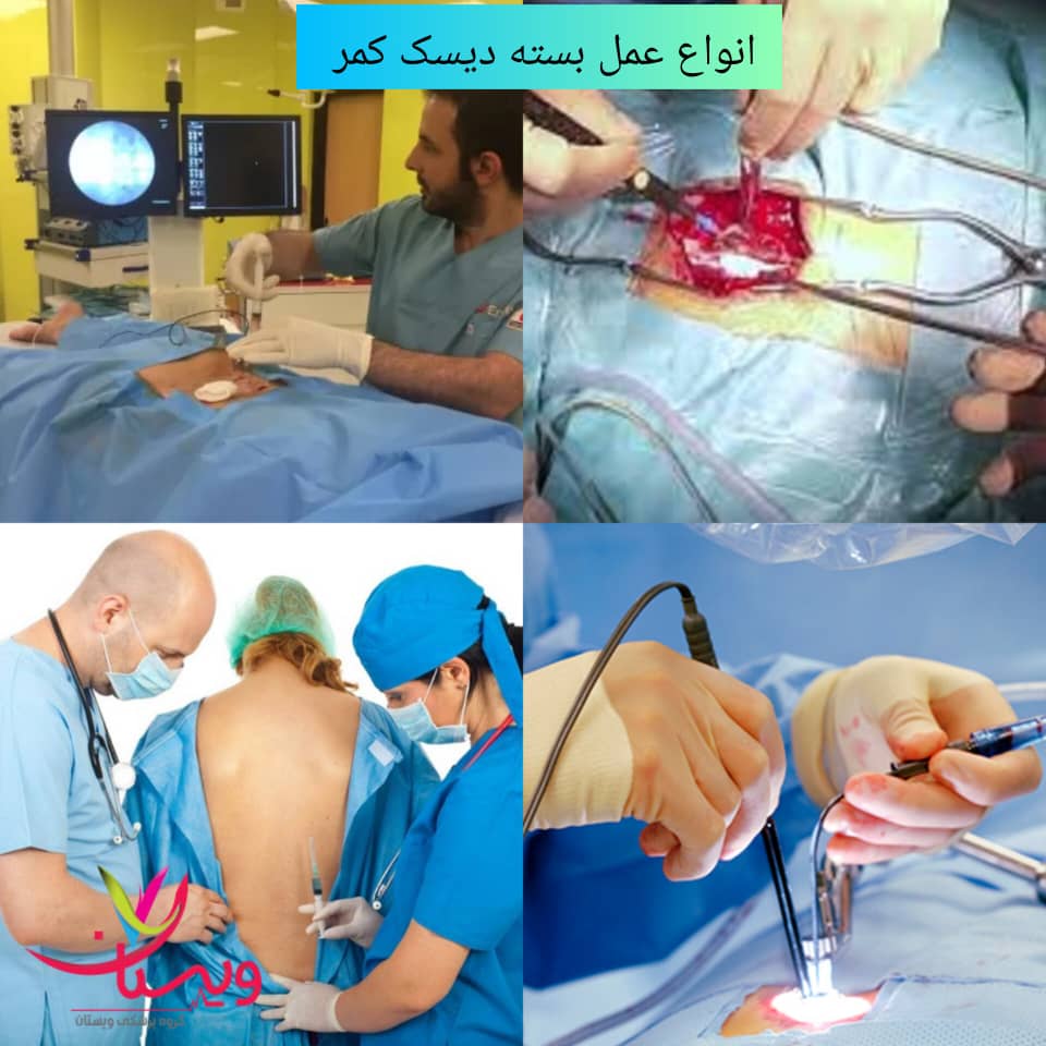 انواع عمل دیسک کمر بسته انواع عمل دیسک کمر بسته