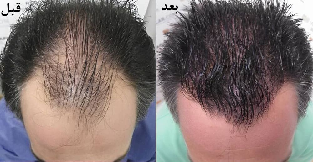 عکس قبل و بعد از پی آر پی مو