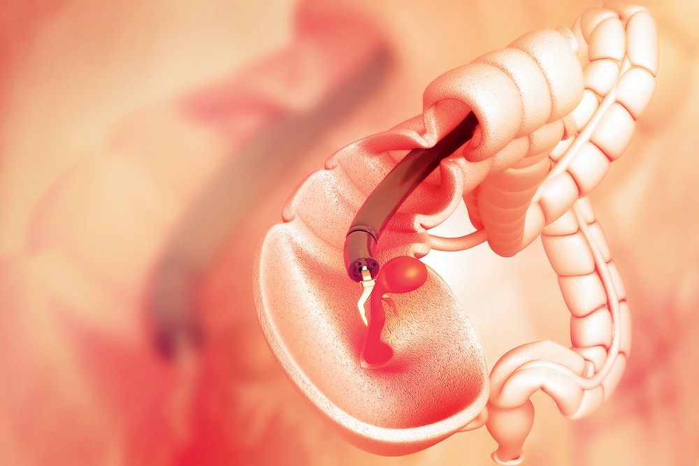 قیمت کولونوسکوپی روده قیمت کولونوسکوپی روده