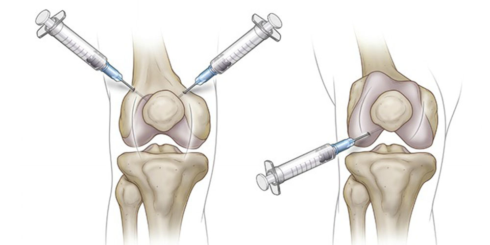 قیمت آمپول غضروف ساز زانو قیمت آمپول غضروف ساز زانو