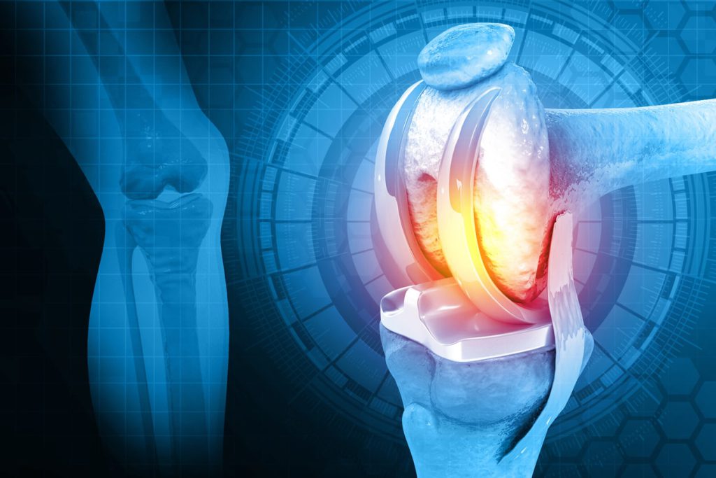 هزینه تعویض مفصل زانو با بیمه تکمیلی کوثر هزینه تعویض مفصل زانو با بیمه تکمیلی کوثر