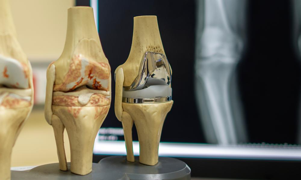 هزینه تعویض مفصل زانو با بیمه سلامت هزینه تعویض مفصل زانو با بیمه سلامت