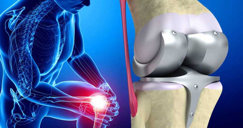 چگونه آمادگی عمل تعویض مفصل زانو را پیدا کنیم؟