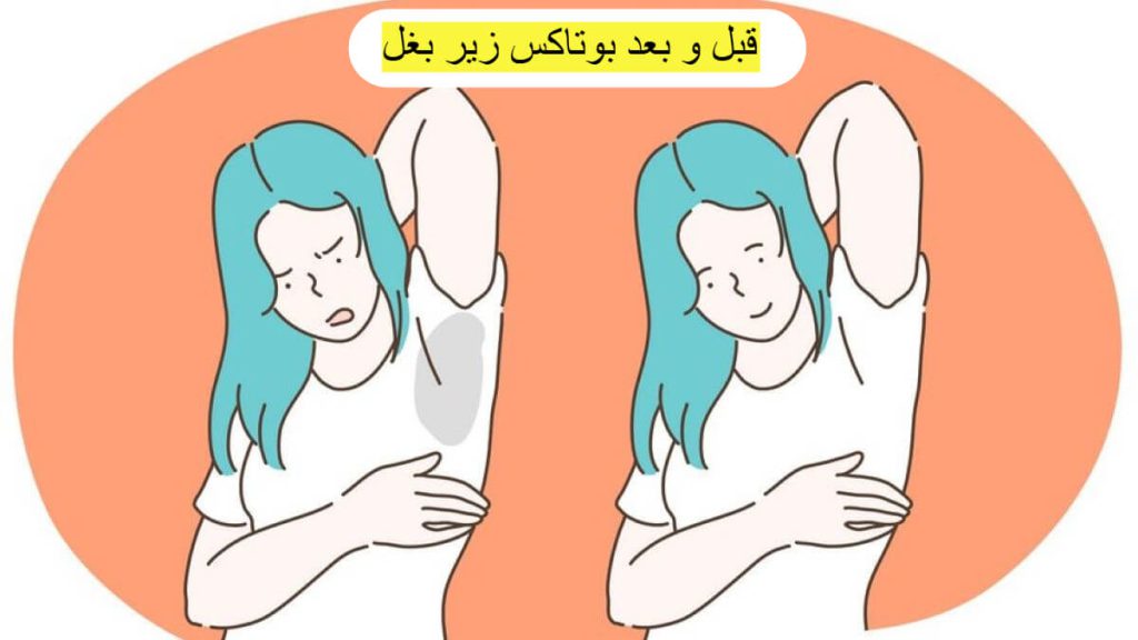 قبل و بعد انجام بوتاکس زیربغل قبل و بعد انجام بوتاکس زیربغل