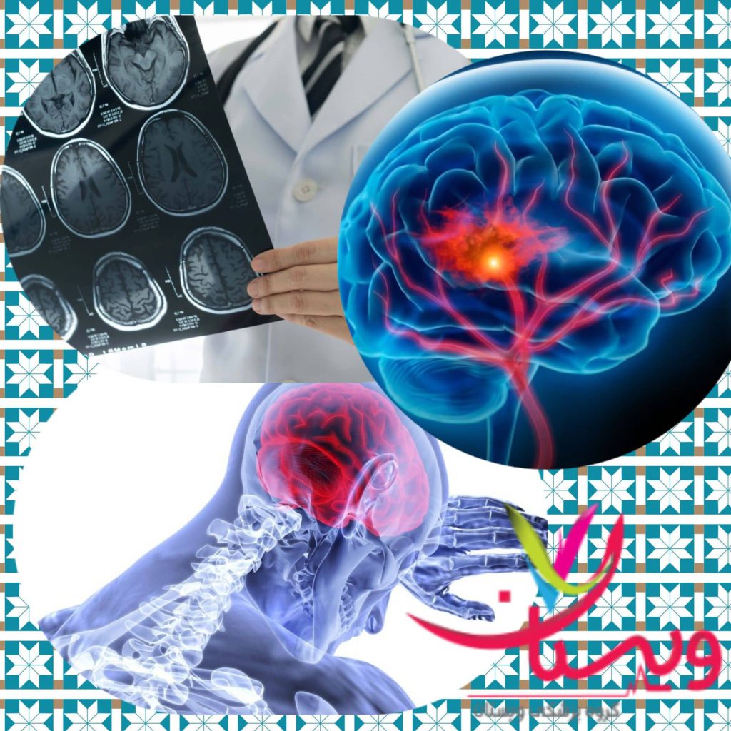 بهترین دکتر برای سکته مغزی در تهران 1404+10 فلوشیپ سکته مغزی