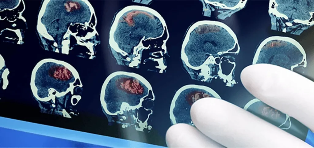 ایا سکته مغزی خوب میشود ایا سکته مغزی خوب میشود