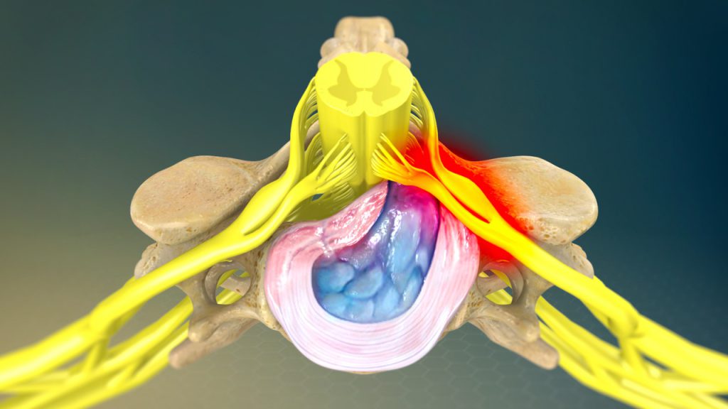 برای دیسک کمر چی خوبه برای دیسک کمر چی خوبه
