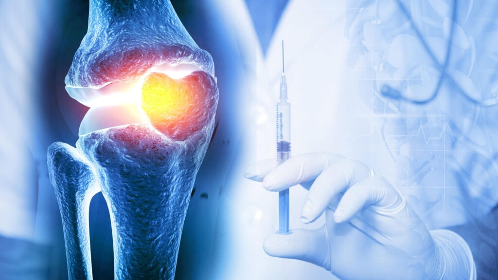 قیمت ژل هیالورونیک اسید برای زانو در داروخانه قیمت ژل هیالورونیک اسید برای زانو در داروخانه