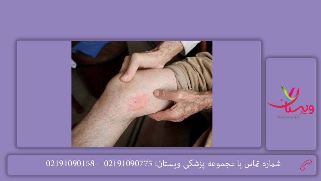 علائم غلظت خون بالا​