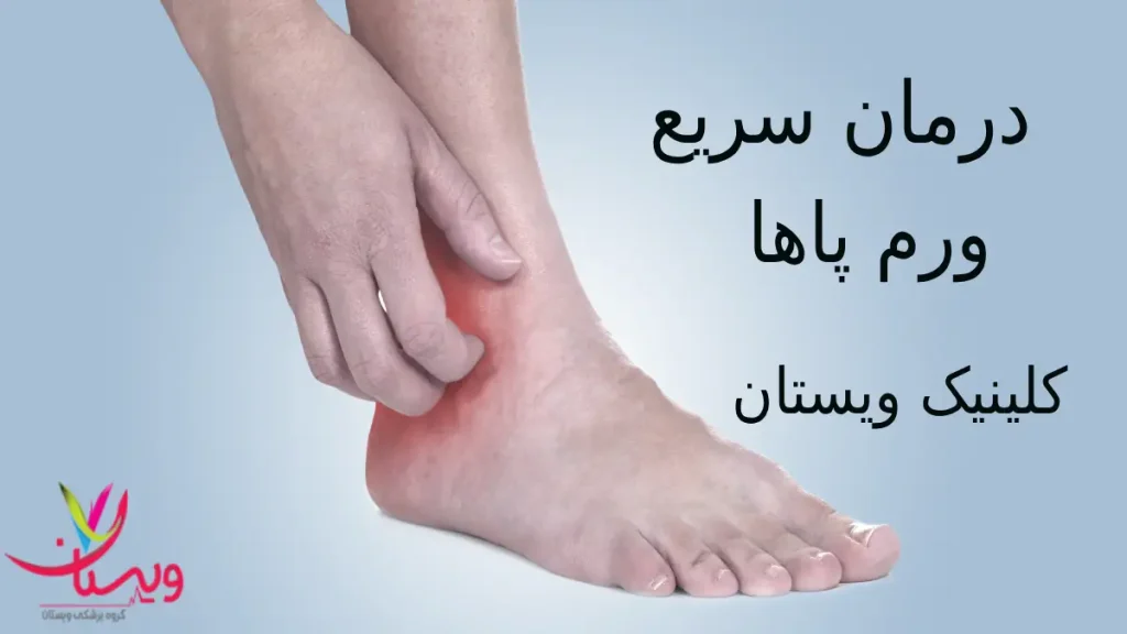 درمان ورم پاها در ویستان درمان ورم پاها